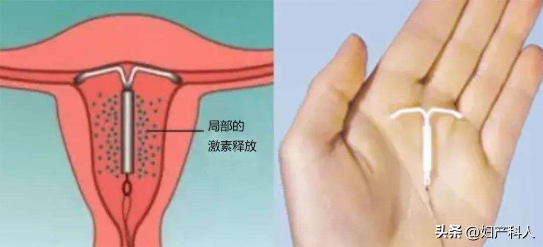 曼月乐又名什么,安了一年的曼月乐