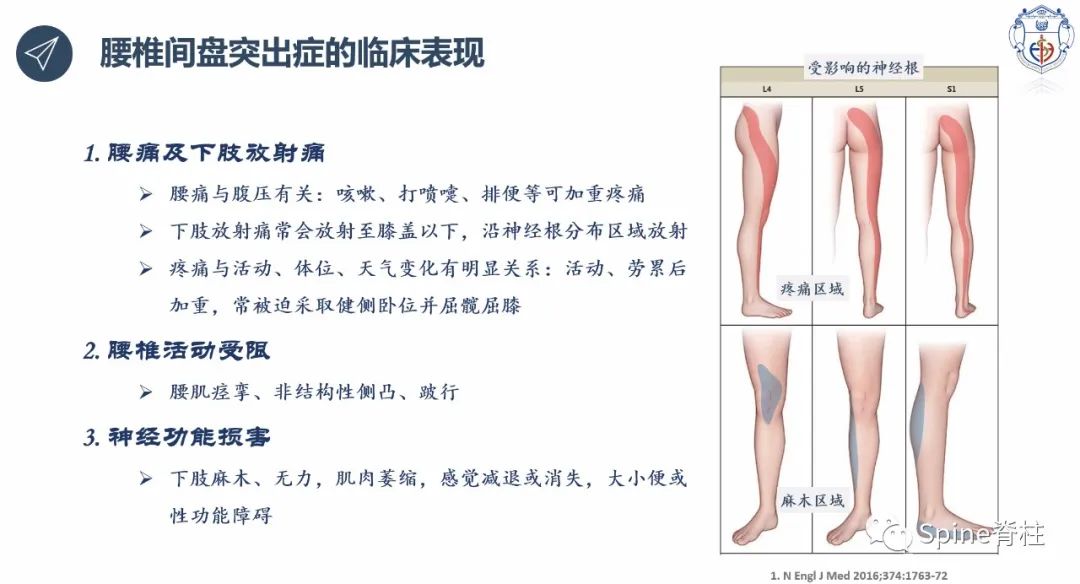 腰椎间盘突出症的治疗方法,腰椎间盘突出症状主要有哪些