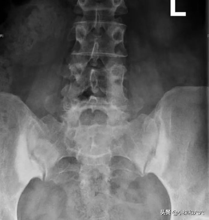 女性腰骶酸痛是怎么回事,致密性骶髂骨炎如何缓解