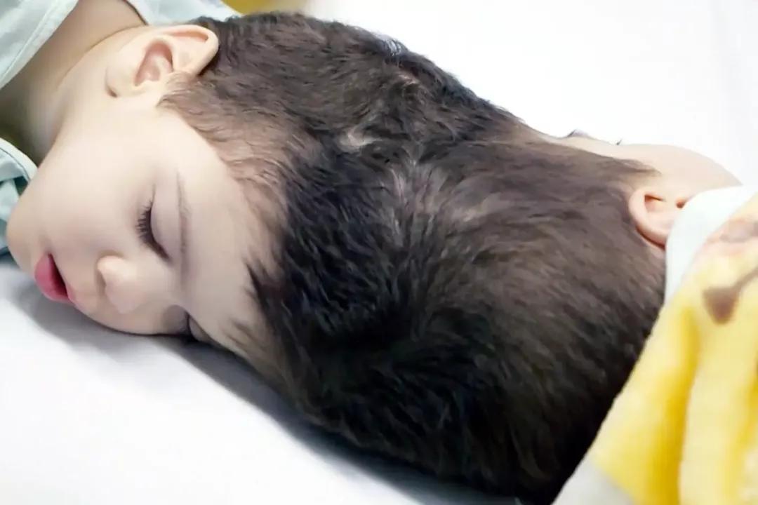 巴西连体双胞胎成功分离后续,巴西头部连体婴儿分离后续