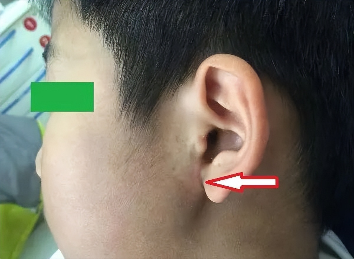 “下巴”外伤莫大意，警惕花式髁突骨折