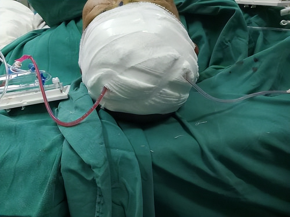 动脉瘤蛛网膜下腔出血术后并发症,动脉瘤导致蛛网膜下腔出血严重吗