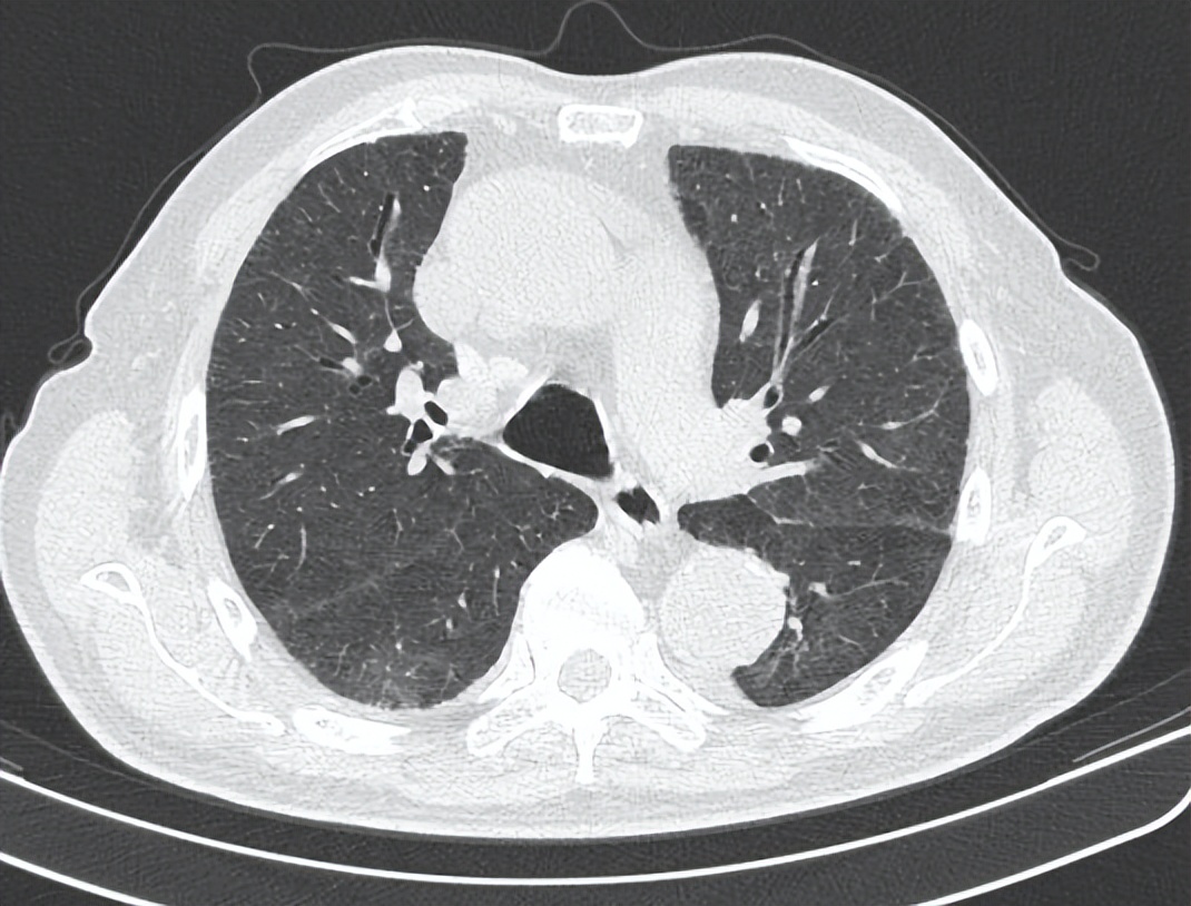 老人新冠后肺部感染严重多久恢复,新冠肺炎症状好转但病灶无明显吸收