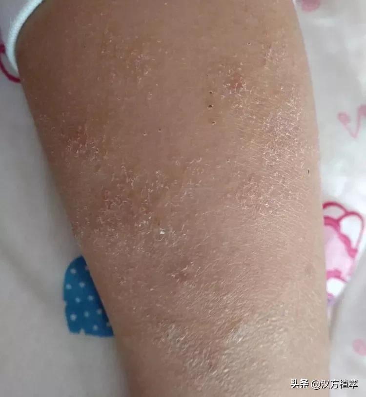 啥？湿疹还有干性的？