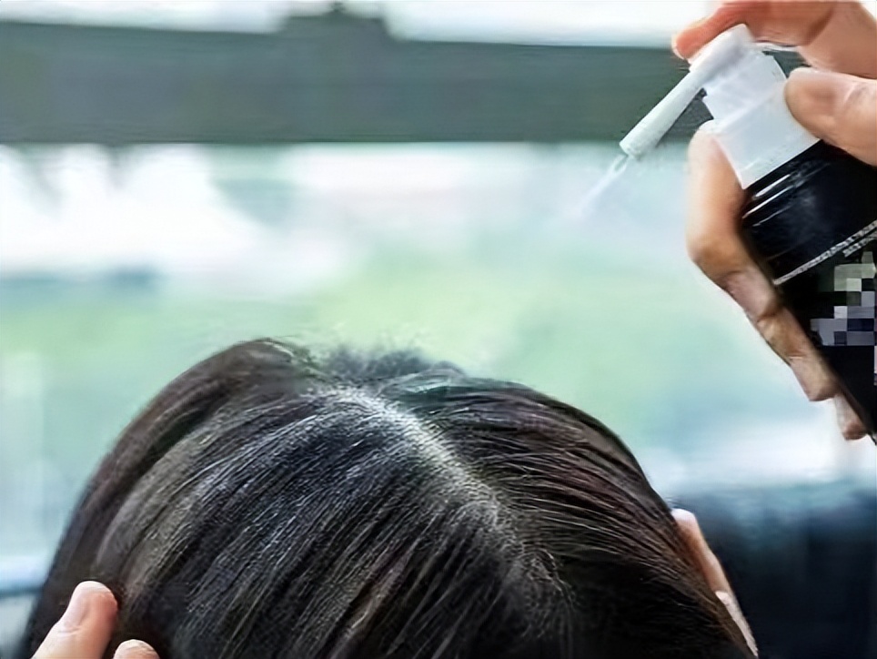 米诺地尔酊用了6个月真实效果 (米诺地尔为什么不建议年轻人用)