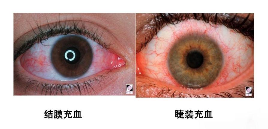 怪不得眼皮一直跳原来是这么回事,为什么眼皮跳真的有事发生了