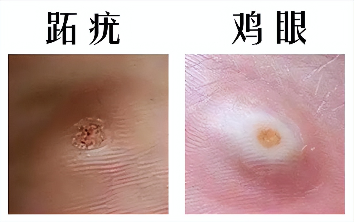 眼睛脖子眼皮有小肉粒是hpv吗,眼睛上的小肉粒是hpv