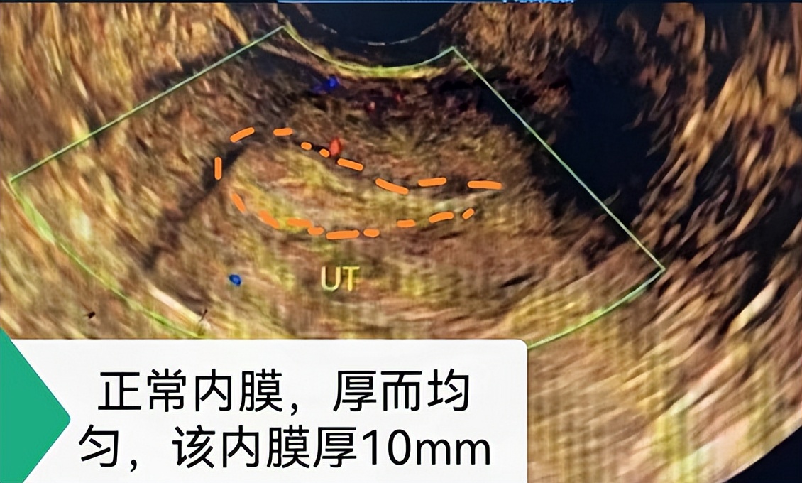 女性宫腔粘连可以做试管婴儿吗,宫腔粘连术后怀孕失败