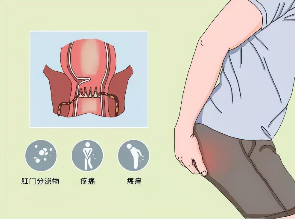 肛瘘手术没挂线是症状比较轻吗,肛瘘症状和痔疮症状有什么区别