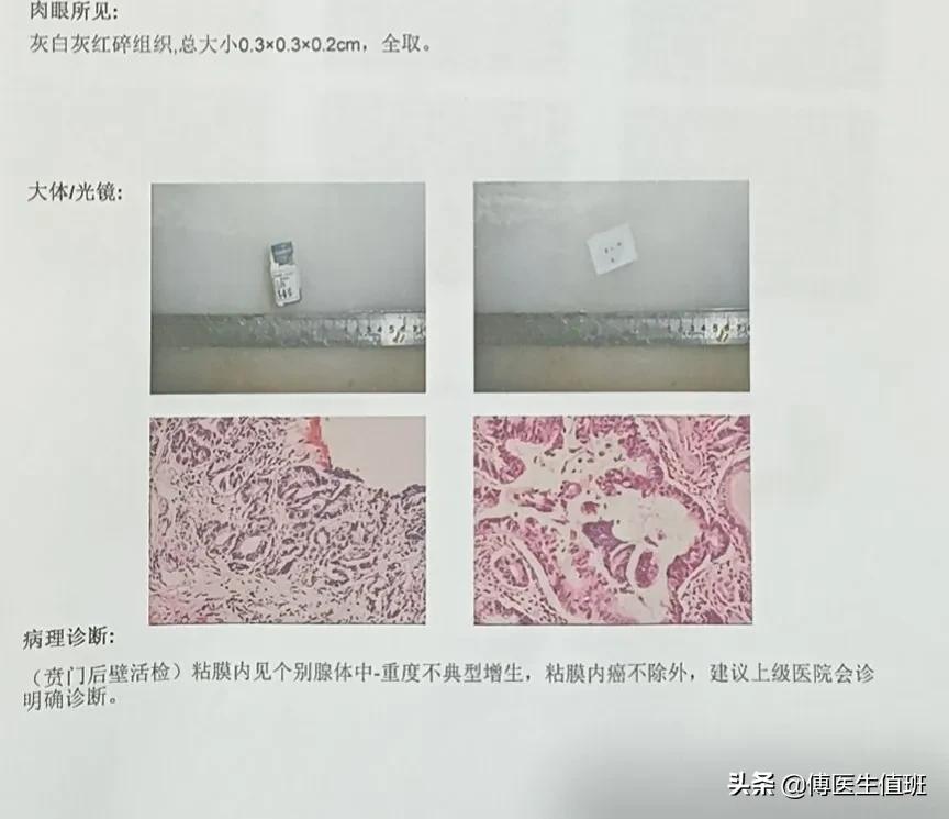 内镜切除贲门至胃底肿瘤,胃镜诊断贲门炎贲门息肉