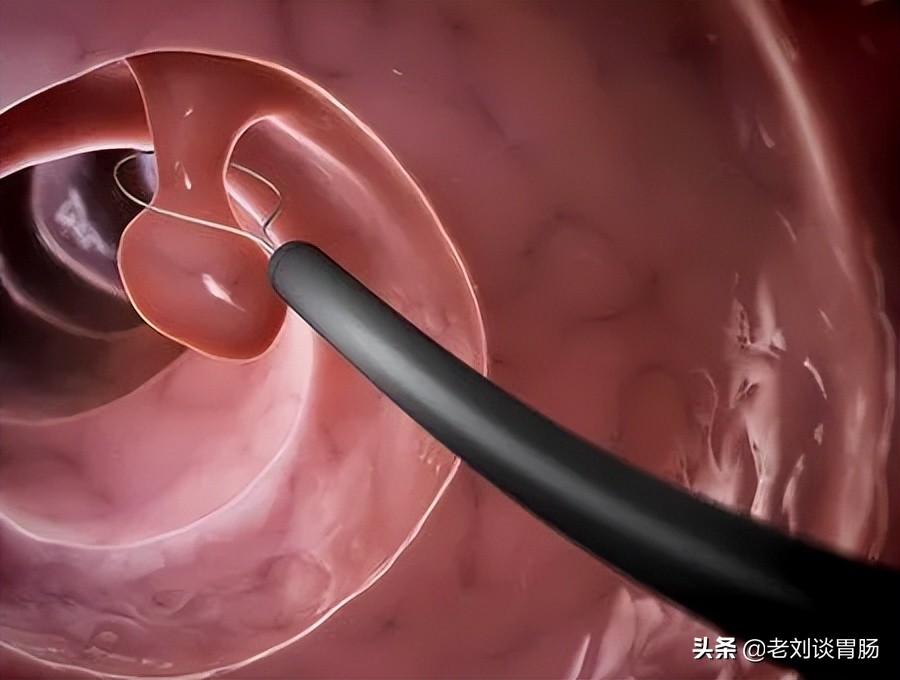 怎么看懂胃镜报告,如何看懂胃镜报告单呢