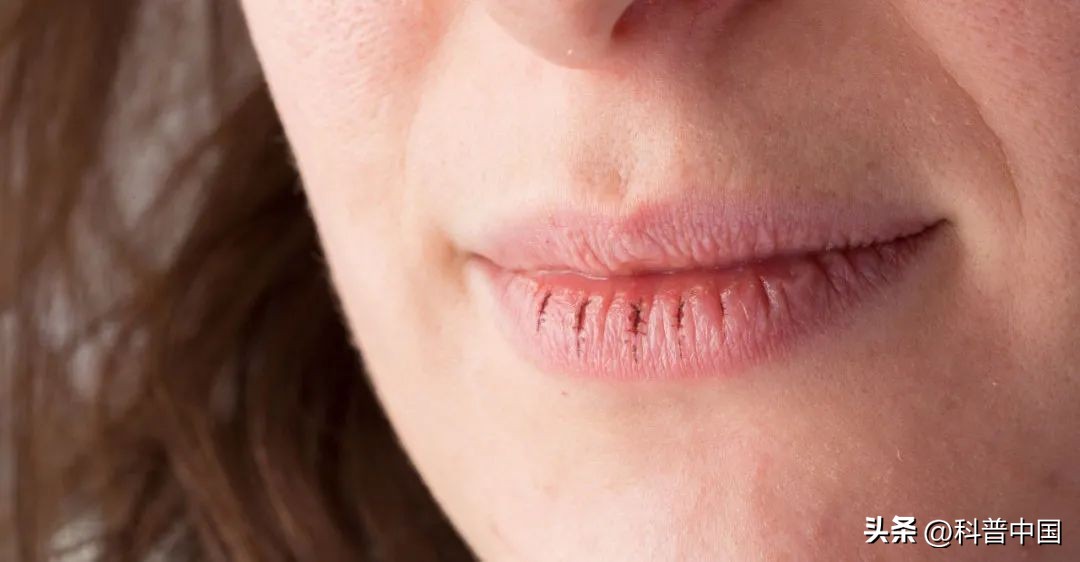 嘴唇越舔越干是什么原因,嘴唇起皮了用舌头舔嘴唇