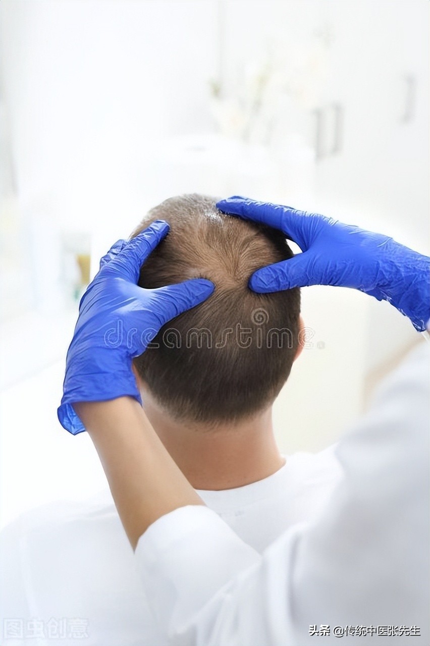 患上斑秃怎么治疗好,治疗斑秃有什么忌口