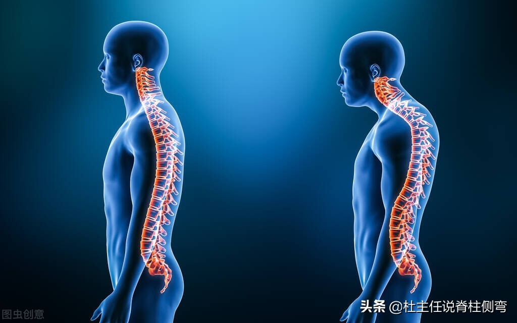 11至14岁青少年更易患脊柱侧弯,脊柱侧弯多少度会出现剃刀背