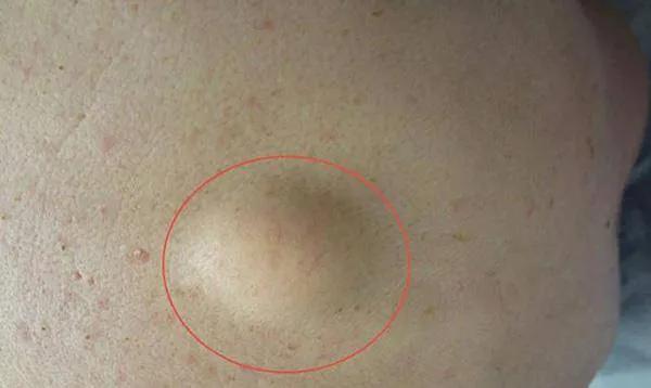 腰部长了一个硬疙瘩像囊肿不疼,腰上长了一个包不痛不痒硬的