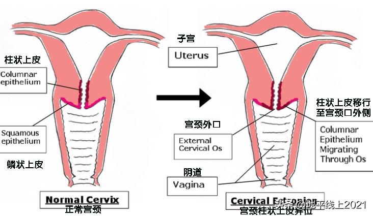 女性宫颈为啥老出问题,宫颈常见问题有哪些