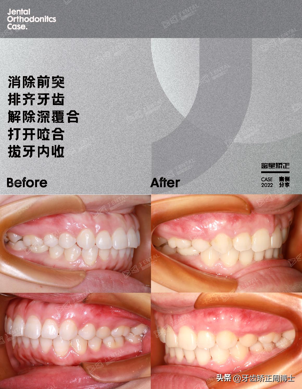 骨性前突正畸后多长时间有效果,牙性下巴后缩可以戴牙套改善吗