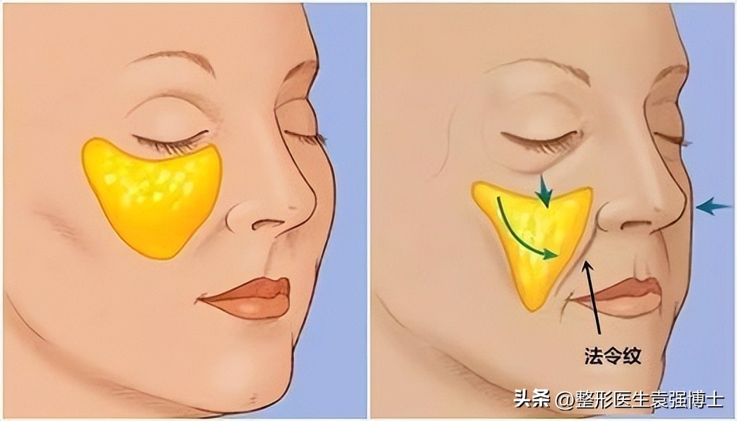 不做拉皮如何改善法令纹,法令纹严重拉皮可以改善吗