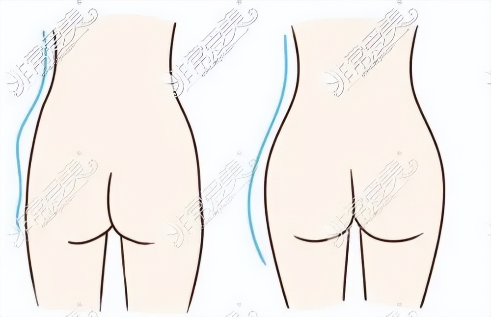 31岁女网红隆臀后高热不退，半边屁股红肿溃烂