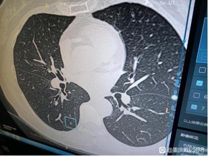 “这是一场爱的接力”，5mm多发磨玻璃结节微浸润腺癌患者感叹