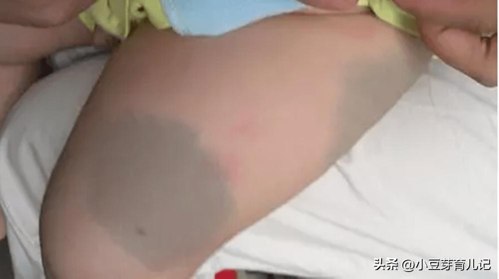 宝宝大腿后突然淤青一块,宝宝大腿有淤青怎么回事