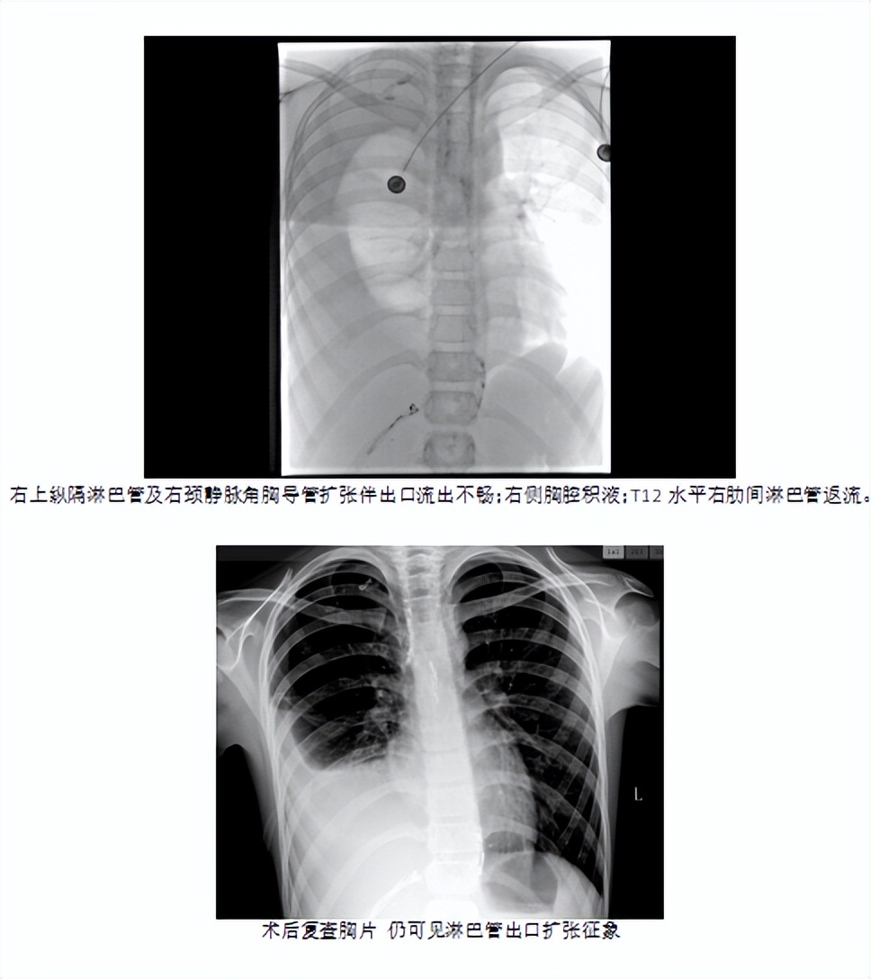 儿童淋巴管瘤的彩超表现,儿童淋巴管畸形哪里能看