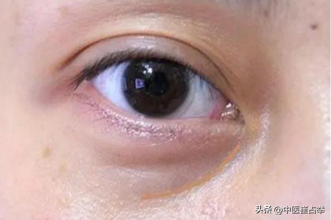 脾虚肾虚引起眼袋黑眼圈吃什么药,眼袋大是肾虚还是脾虚吃什么食材