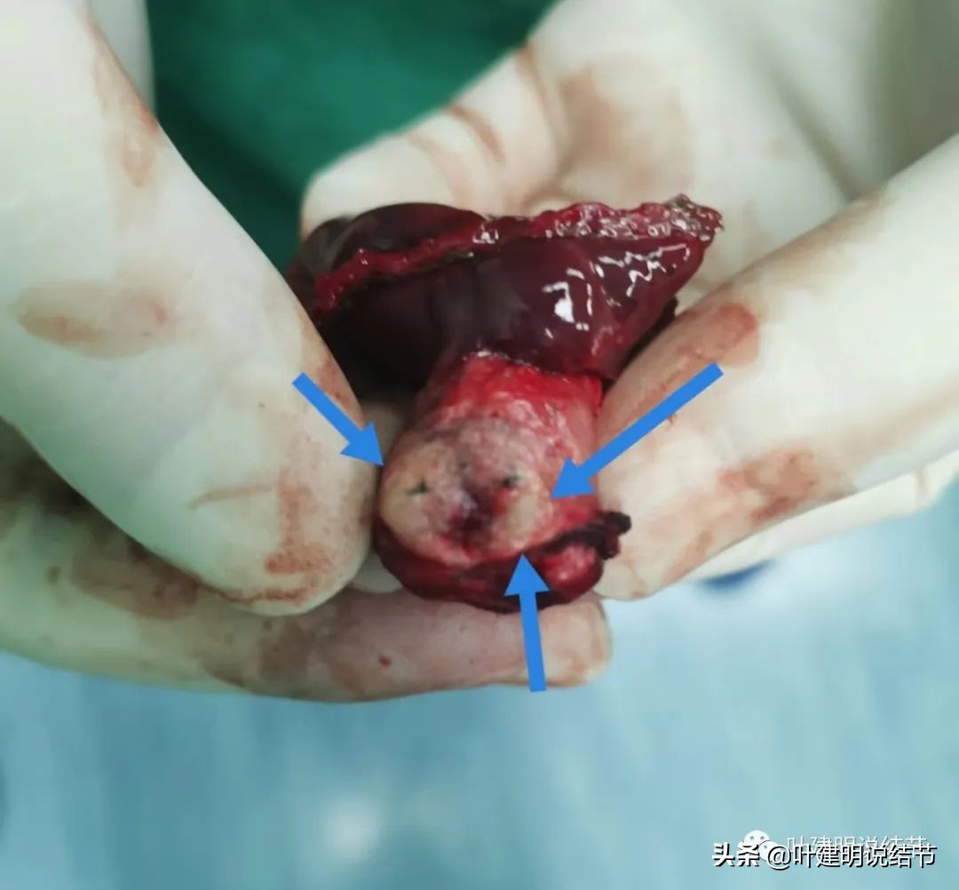 2cm的肺磨玻璃结节如何处理最合适,年轻女人磨玻璃结节