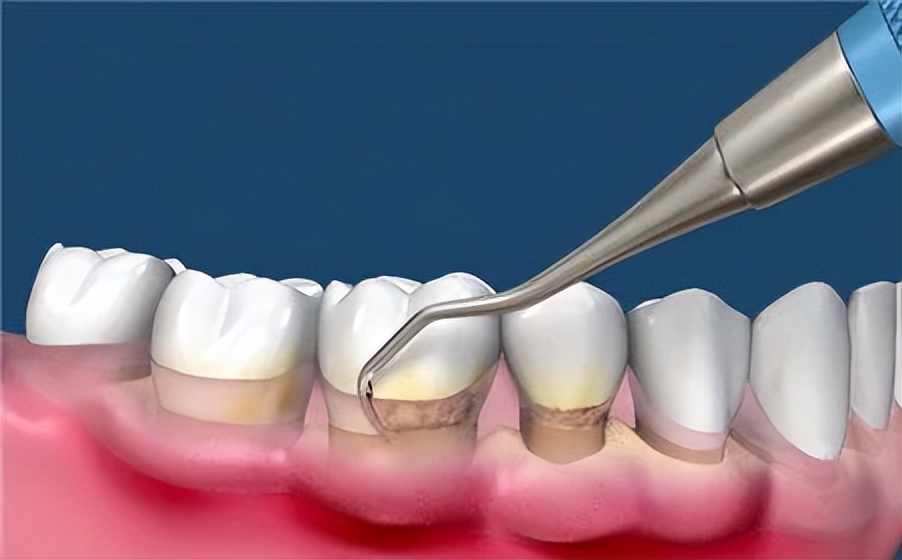 牙齿松了怎么补救最快,牙齿松了能补救吗