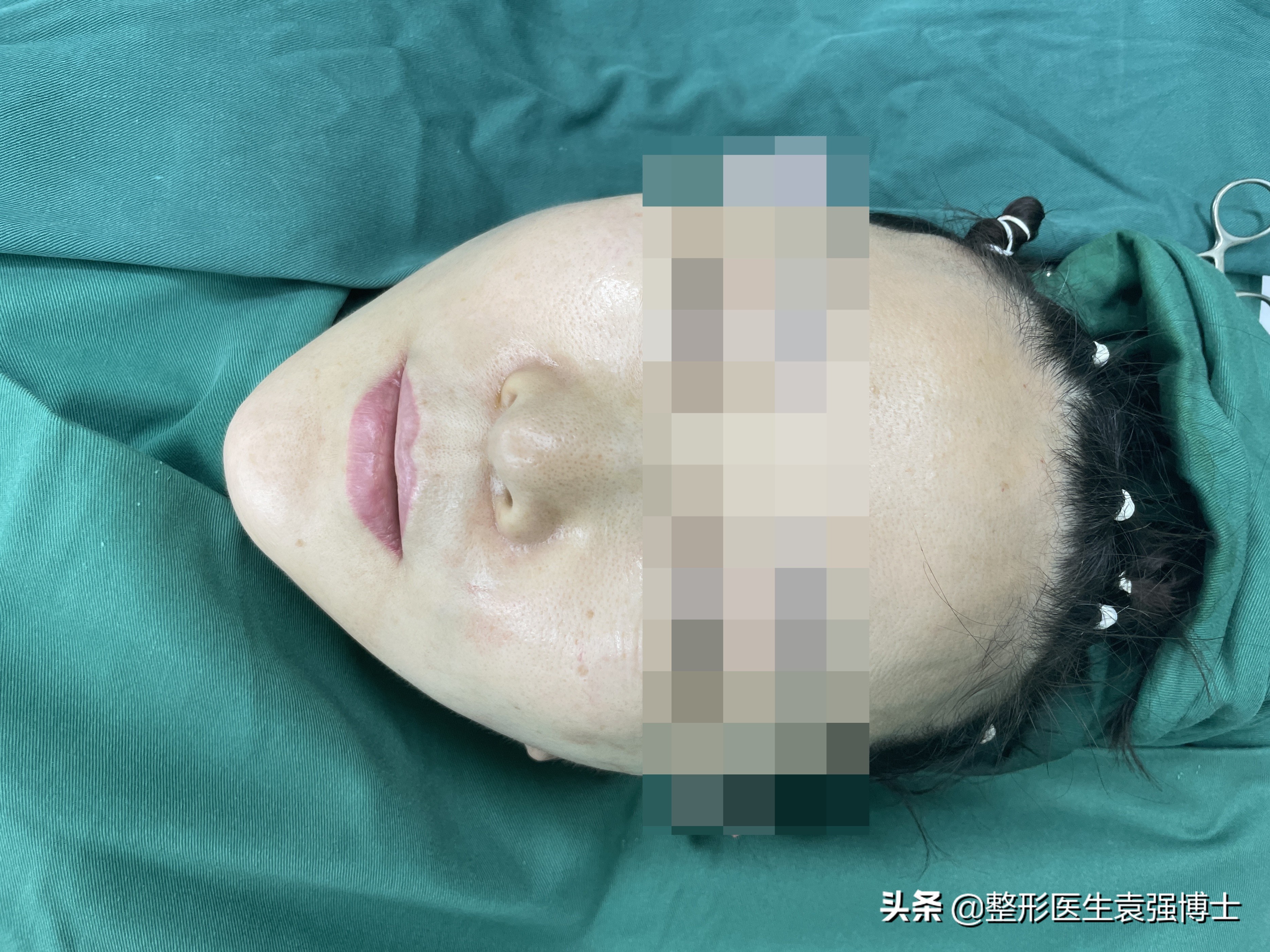 拉皮手术是额头切口还是耳前切口,拉皮手术耳前切