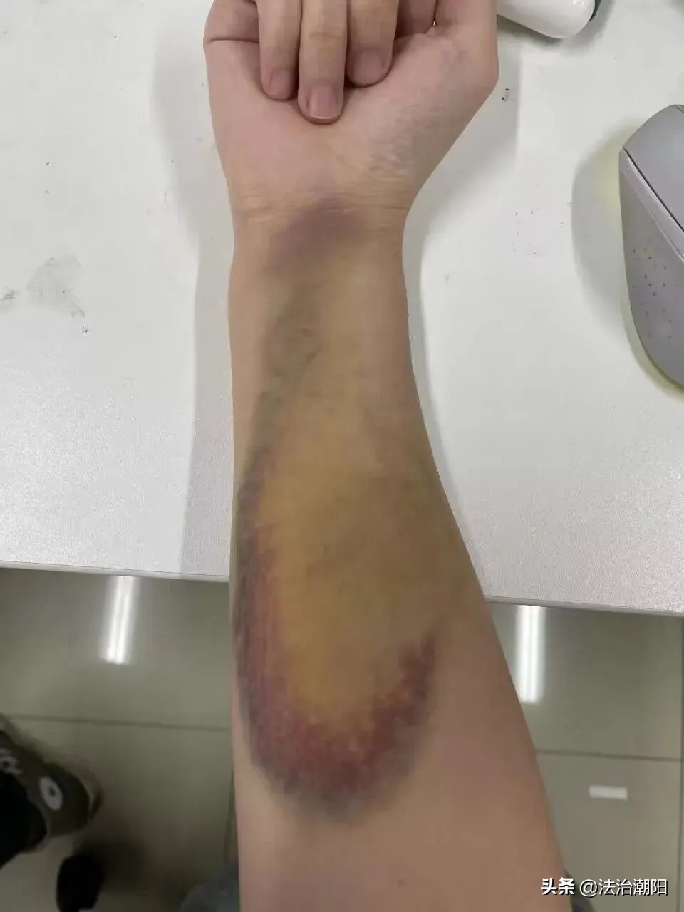 女研究生为救轻生者胳膊被咬淤青,研究生救轻生女子