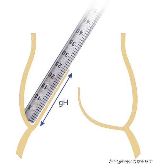 最先进的主动脉瓣二瓣叶畸形修复术（2020版）