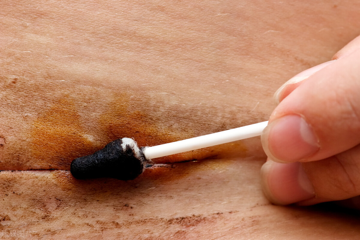 剖腹产疤痕宝妈们用什么修复,剖宫产疤痕憩室怎么去除