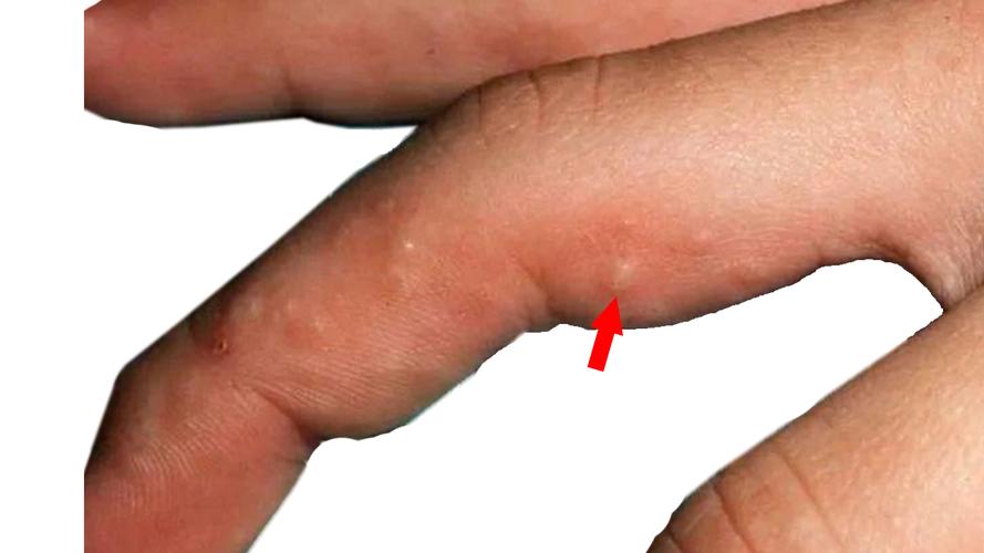 突发汗疱疹怎么办,如何缓解汗疱疹的灼热