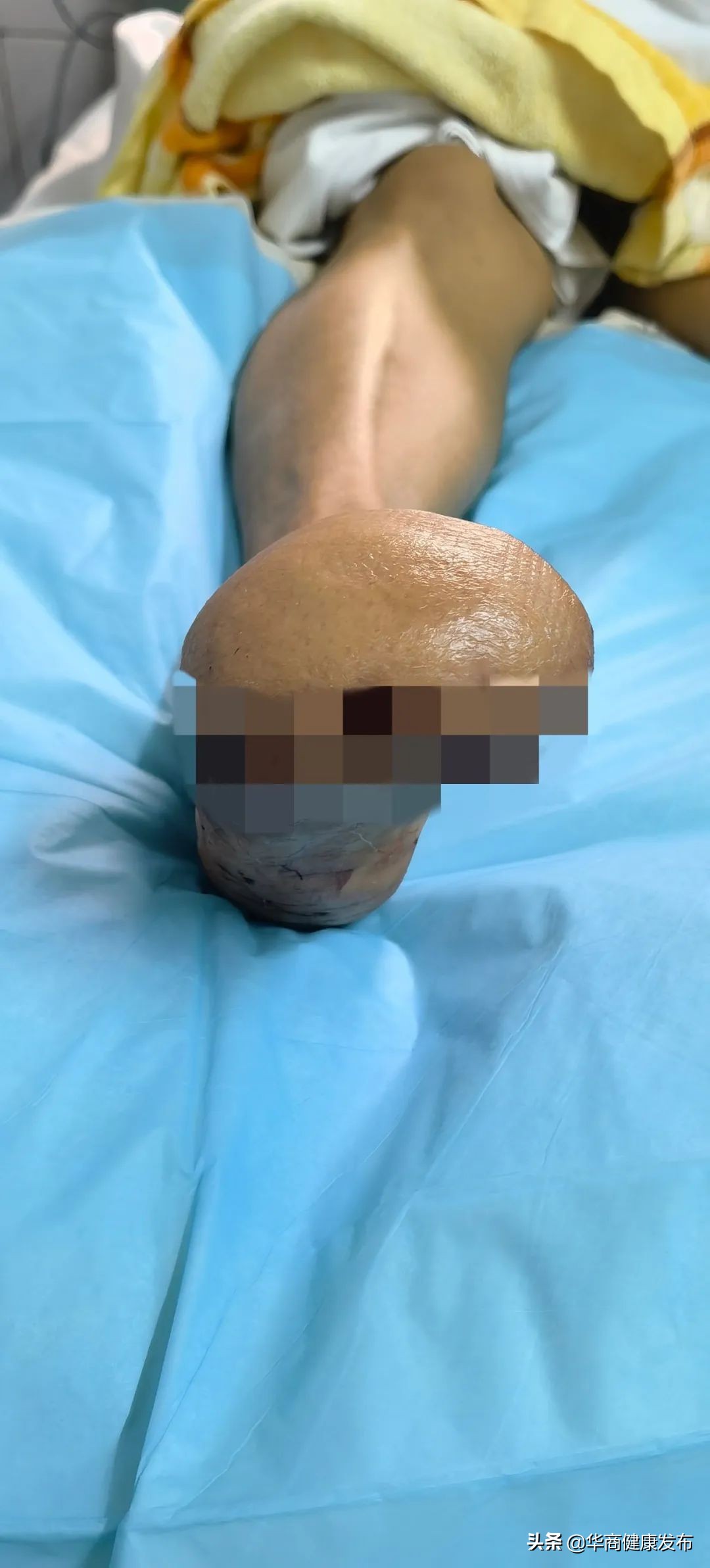 -30°低温冻伤双脚三次手术为其保留“残足长度”