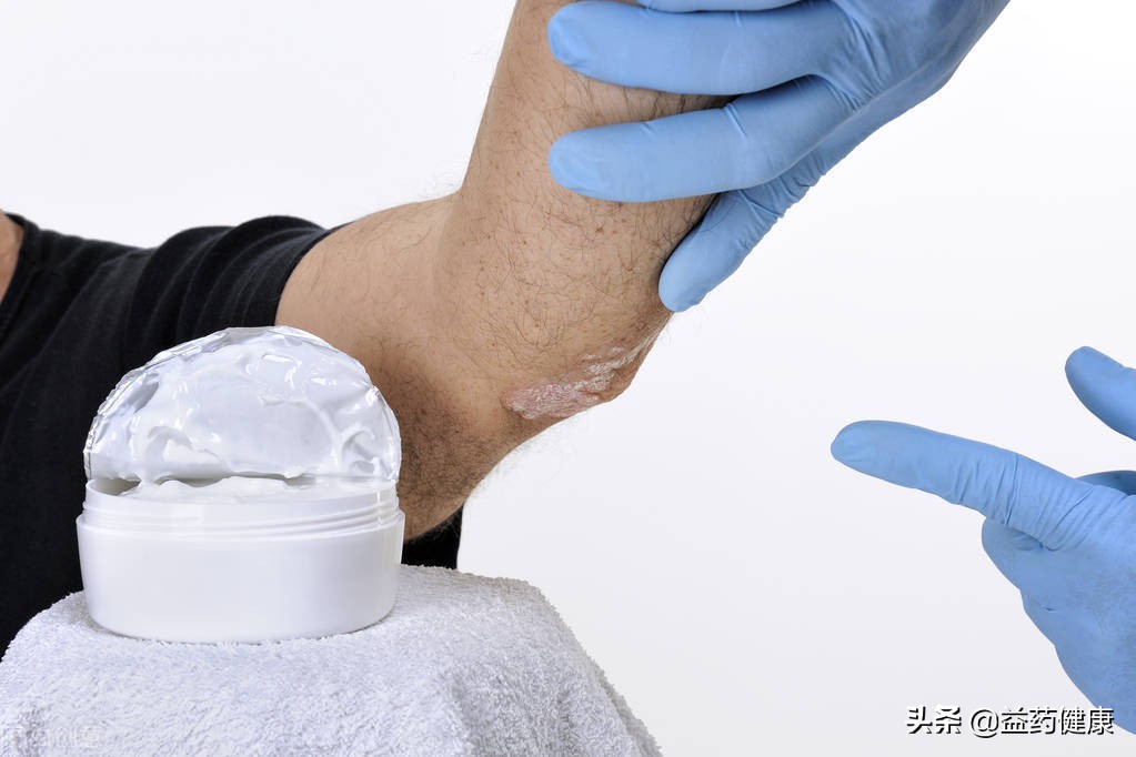 脸部红斑并脱出银白色鳞屑，是银屑病吗？该如何正确治疗