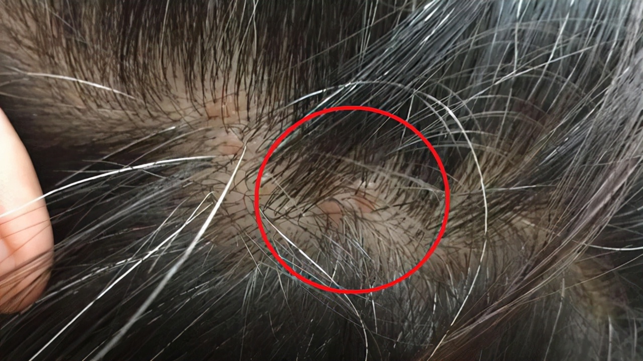 头皮上总出油长有疙瘩或脓包,头皮总是长疙瘩或脓包是什么原因