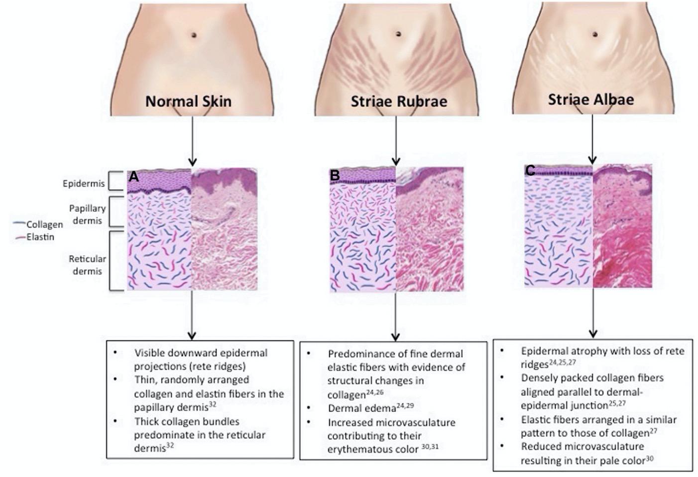有效祛妊娠纹的产品推荐,妊娠纹产品前十名