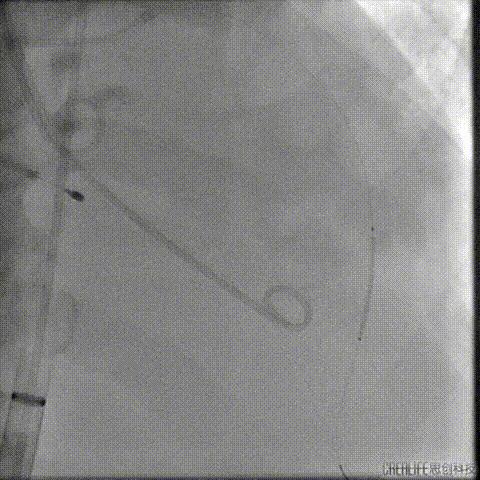病例回顾与分享,腹膜后血肿介入治疗