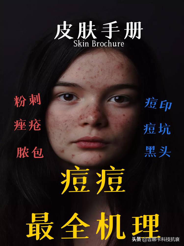 如何祛痘妙招,最简单高效祛痘方法