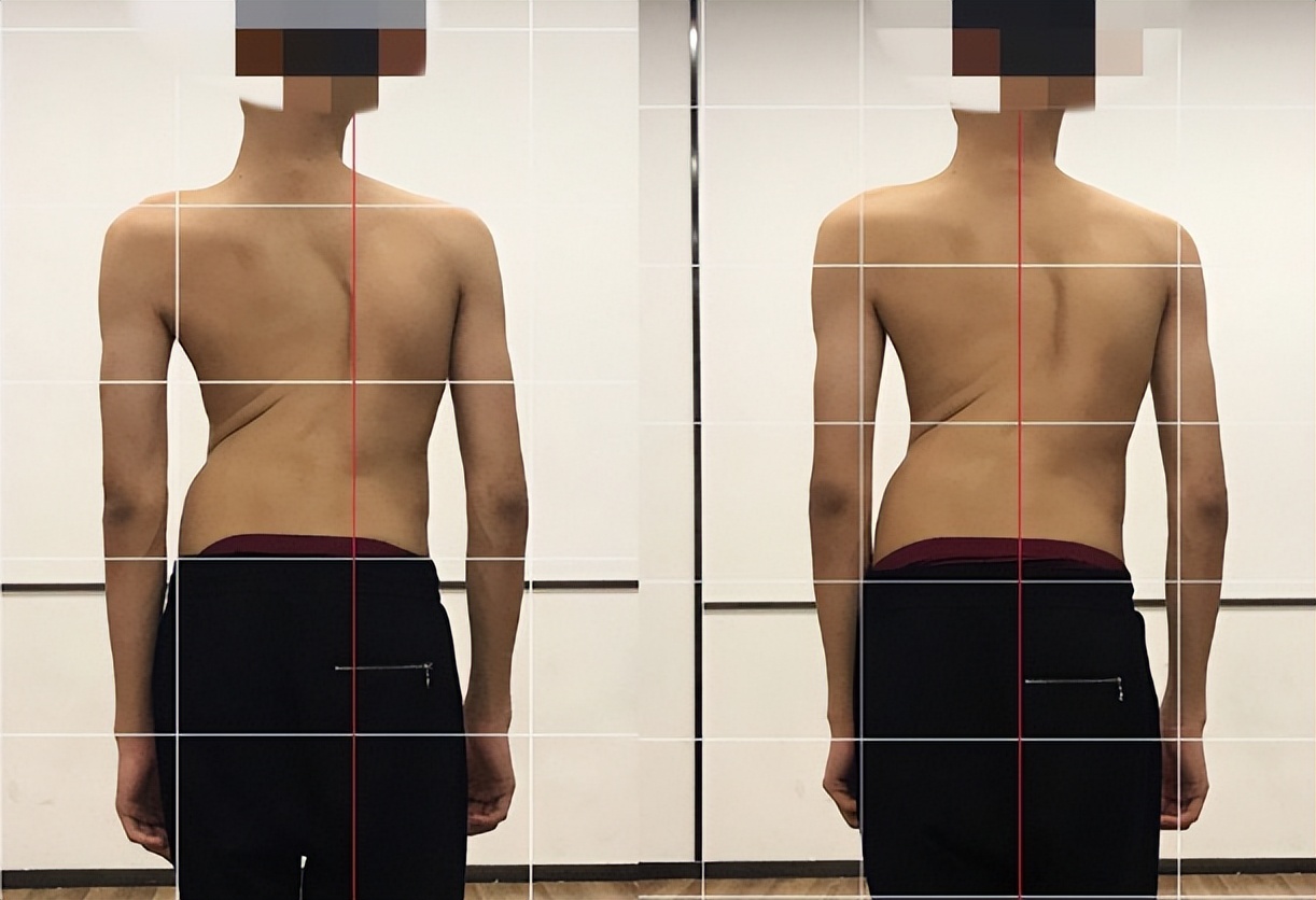 孩子脊柱侧弯肩膀不对称怎么矫正,脊柱侧弯导致孩子太瘦怎么办