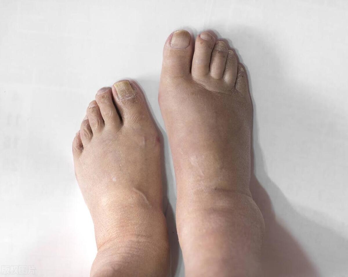 尿少尿黄尿无力伴有手指有些肿胀,尿少下肢浮肿是怎么回事