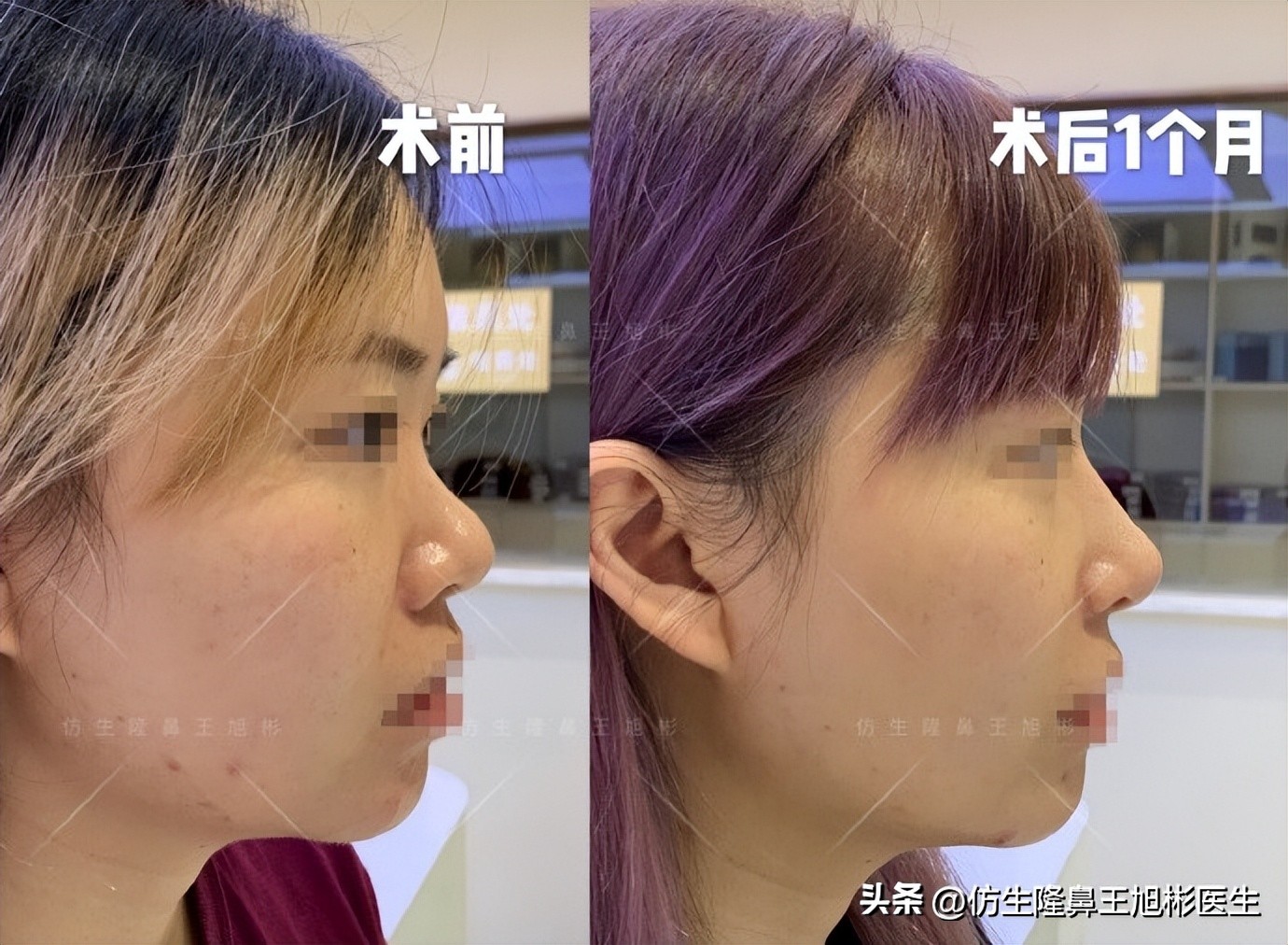 短鼻延长,短鼻塌鼻可以逆袭变长吗