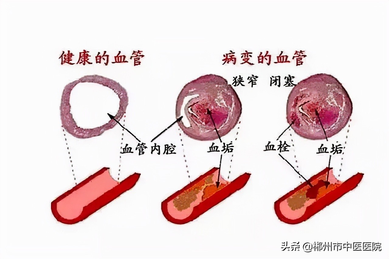 血栓外痔破了该怎么办,面对心血管病最好的办法