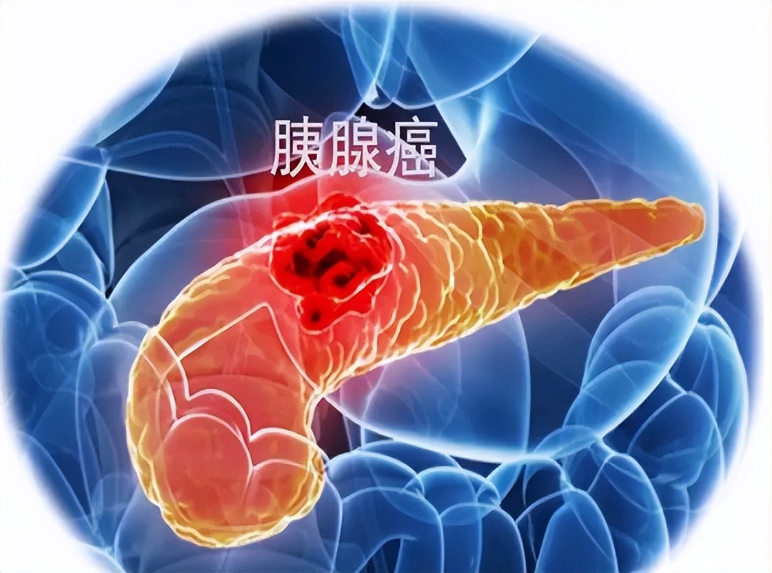 慢性炎症患者怎样预防癌变,慢性炎症诱发肿瘤