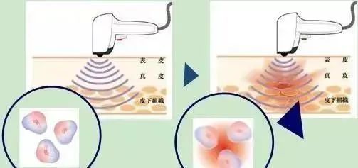 光子嫩肤哪个好,光子嫩肤哪种光波最好