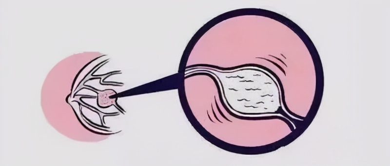 囊肿里边是一个水泡,囊肿是小水泡嘛