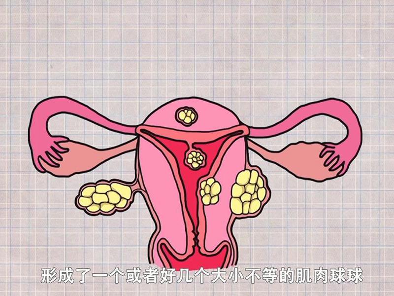 子宫肌瘤为什么会引起女性不孕？
