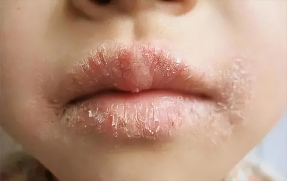 冬季皮肤皲裂,冬季皮肤皲裂怎么办