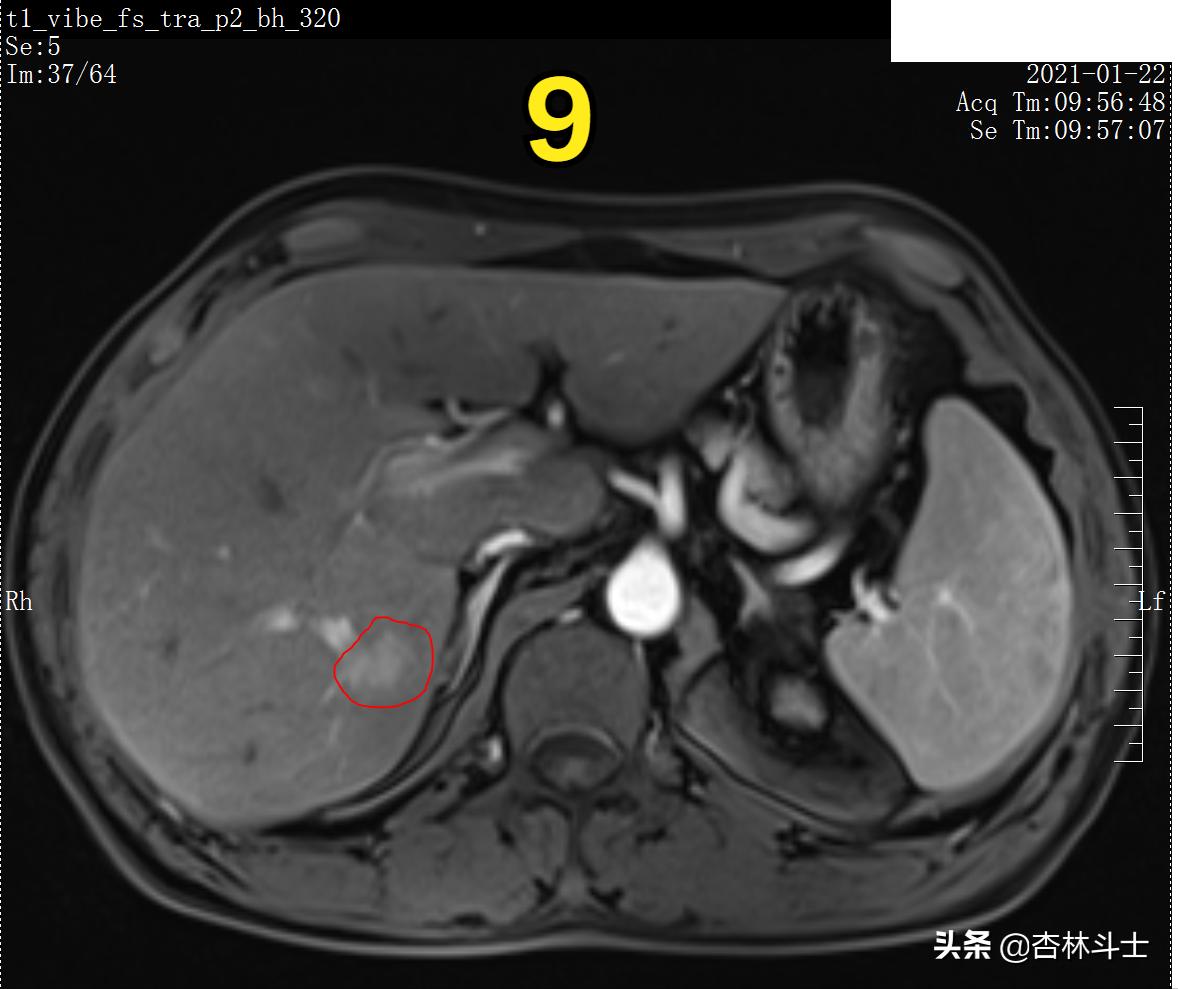 肝癌8公分肿瘤能活多久,肝癌细胞最大长多大